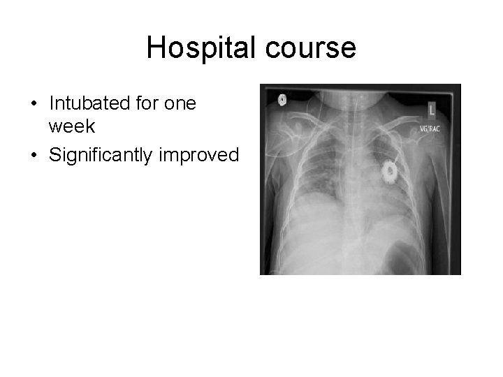 Hospital course • Intubated for one week • Significantly improved 