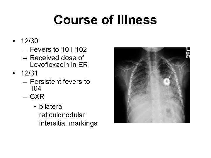 Course of Illness • 12/30 – Fevers to 101 -102 – Received dose of