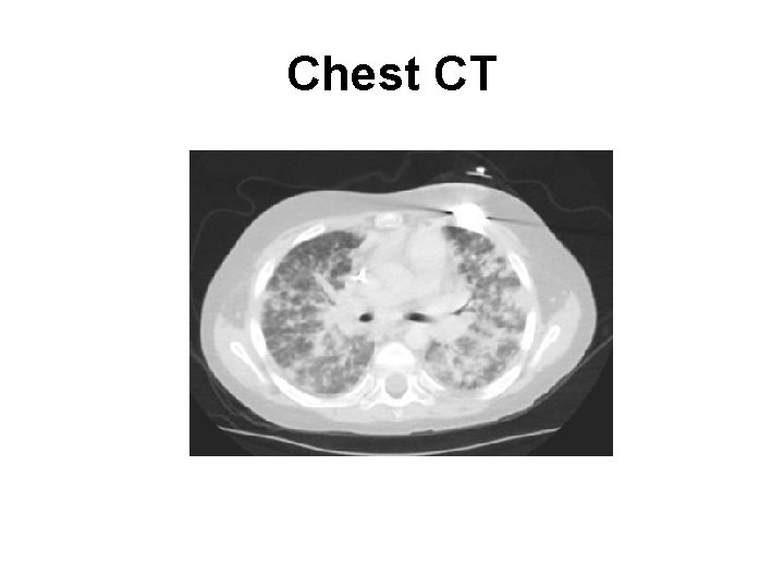Chest CT 