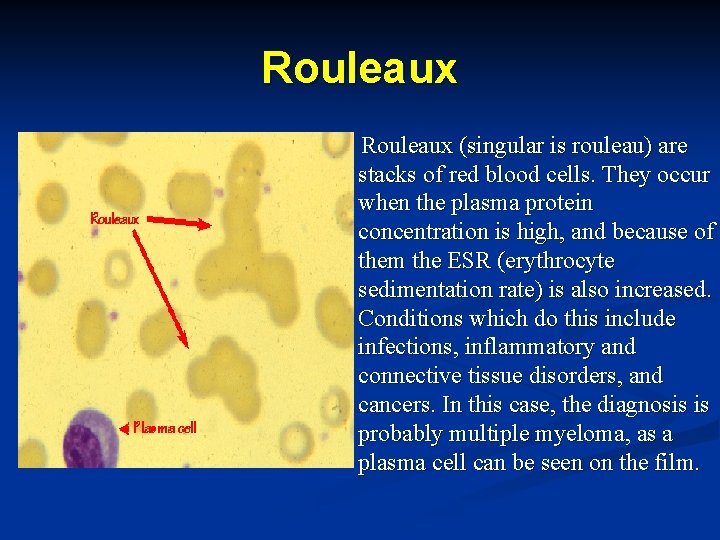 Rouleaux (singular is rouleau) are stacks of red blood cells. They occur when the