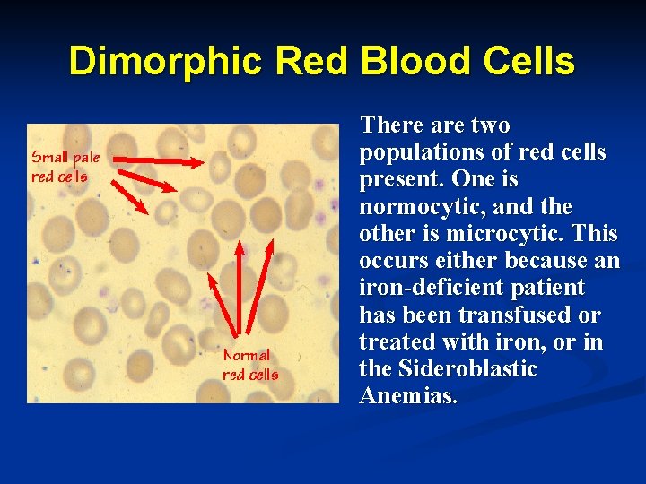 Dimorphic Red Blood Cells There are two populations of red cells present. One is