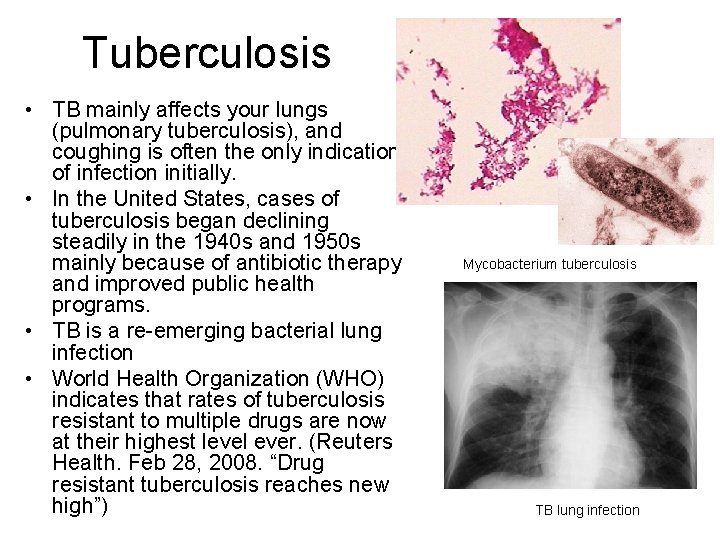 Tuberculosis • TB mainly affects your lungs (pulmonary tuberculosis), and coughing is often the