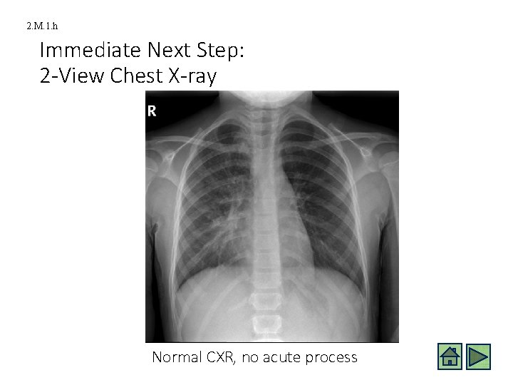 2. M. 1. h Immediate Next Step: 2 -View Chest X-ray Normal CXR, no