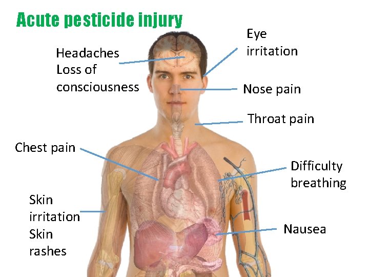 Acute pesticide injury Headaches Loss of consciousness Eye irritation Nose pain Throat pain Chest