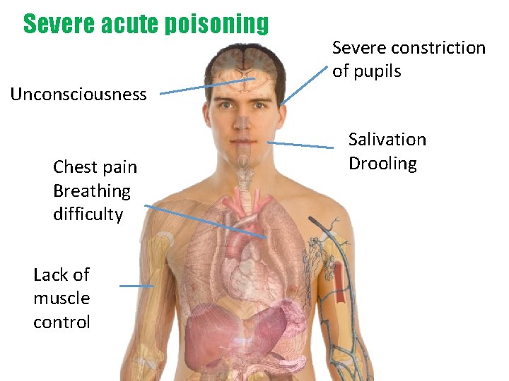 Severe acute poisoning Unconsciousness Chest pain Breathing difficulty Lack of muscle control Severe constriction