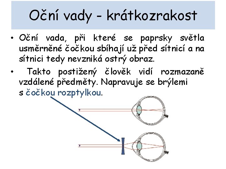 Oční vady - krátkozrakost • Oční vada, při které se paprsky světla usměrněné čočkou