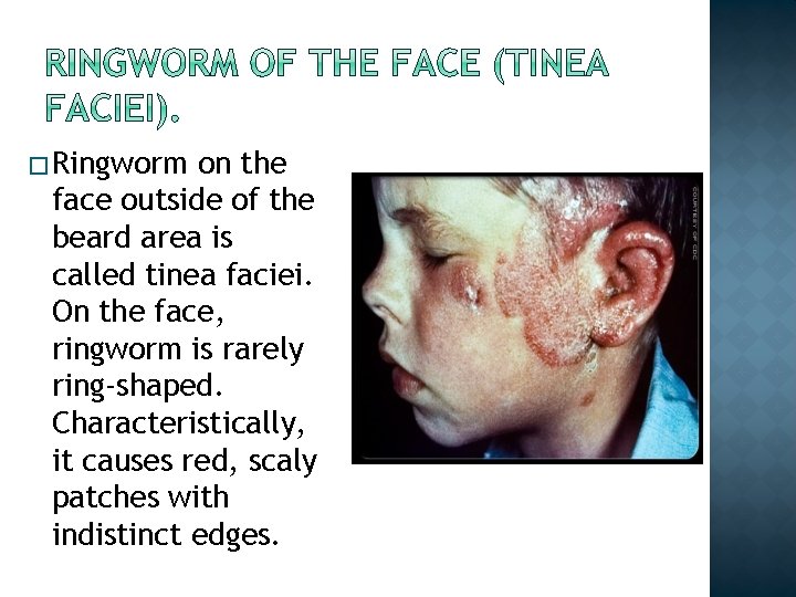 � Ringworm on the face outside of the beard area is called tinea faciei.