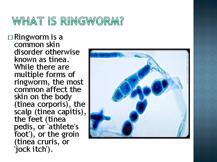 � Ringworm is a common skin disorder otherwise known as tinea. While there are