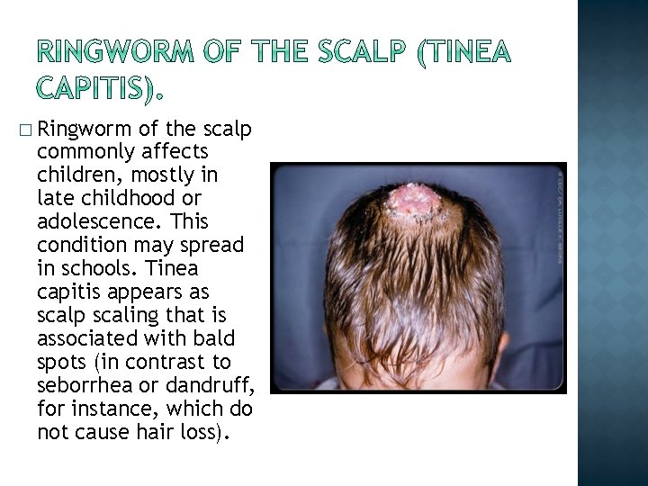 � Ringworm of the scalp commonly affects children, mostly in late childhood or adolescence.