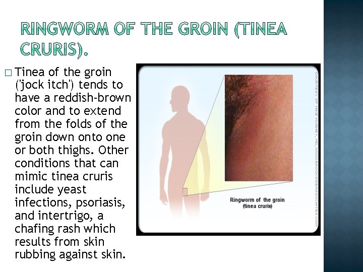 � Tinea of the groin ('jock itch') tends to have a reddish-brown color and