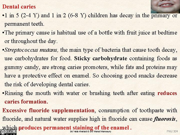 Dental caries • 1 in 5 (2 -4 Y) and 1 in 2 (6