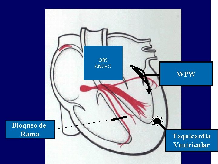 QRS ANCHO WPW Bloqueo de Rama Taquicardia Ventricular 