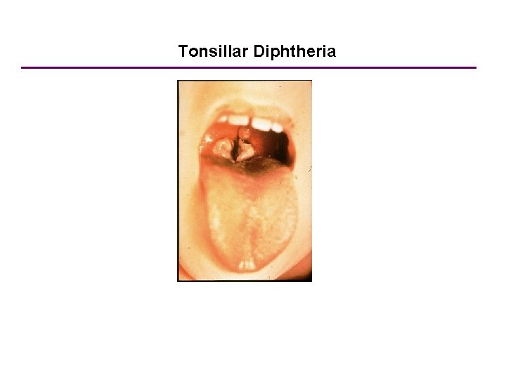 Tonsillar Diphtheria 