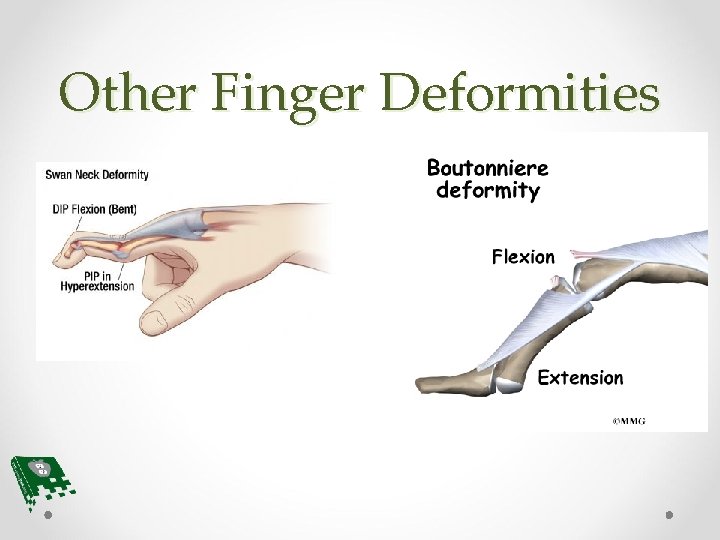 Other Finger Deformities 