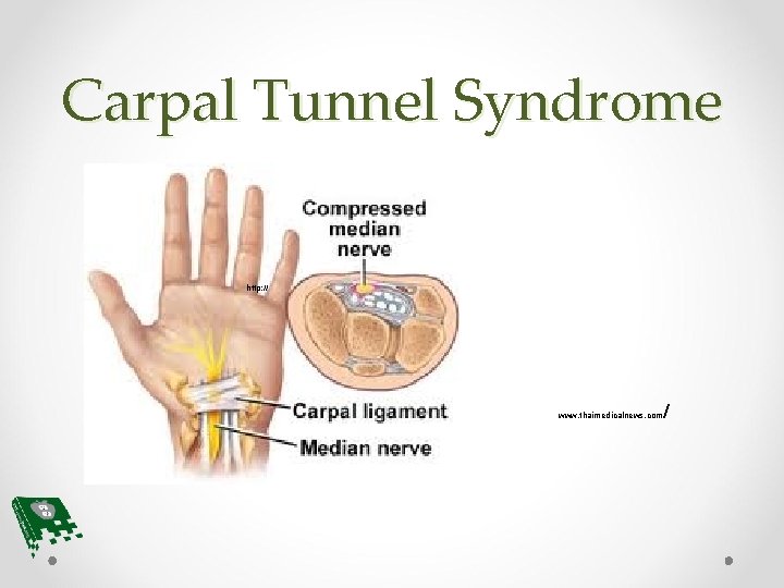 Carpal Tunnel Syndrome http: // www. thaimedicalnews. com / 