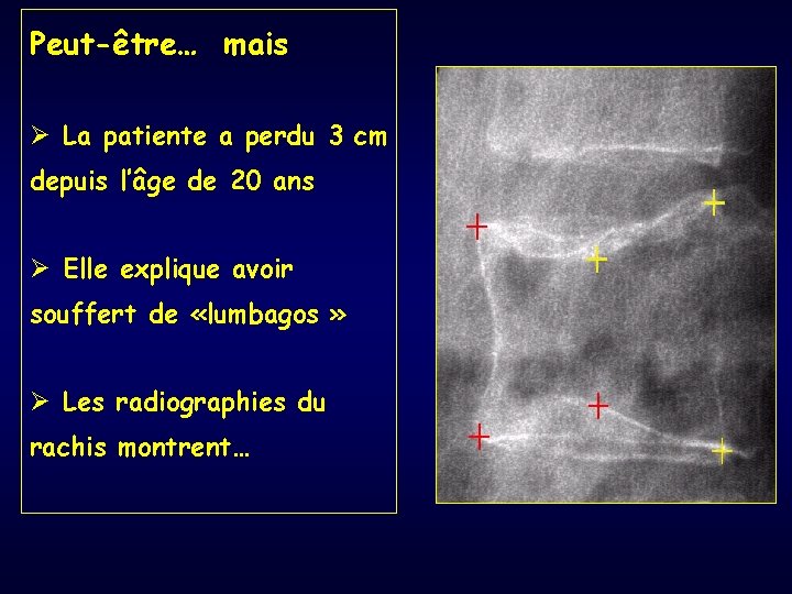 Peut-être… mais Ø La patiente a perdu 3 cm depuis l’âge de 20 ans