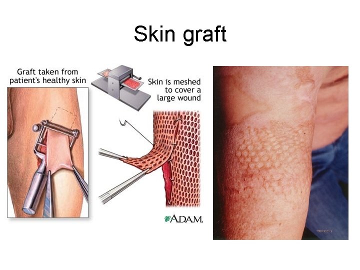 Skin graft 