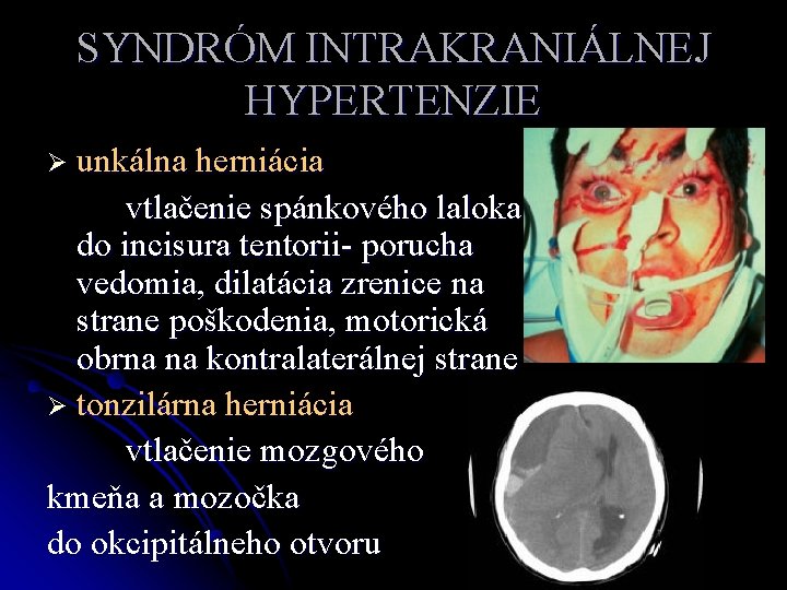 SYNDRÓM INTRAKRANIÁLNEJ HYPERTENZIE Ø unkálna herniácia vtlačenie spánkového laloka do incisura tentorii- porucha vedomia,