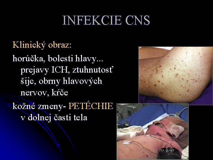 INFEKCIE CNS Klinický obraz: horúčka, bolesti hlavy. . . prejavy ICH, ztuhnutosť šije, obrny