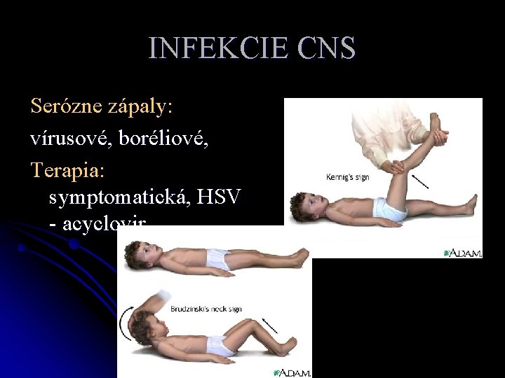 INFEKCIE CNS Serózne zápaly: vírusové, boréliové, Terapia: symptomatická, HSV - acyclovir 