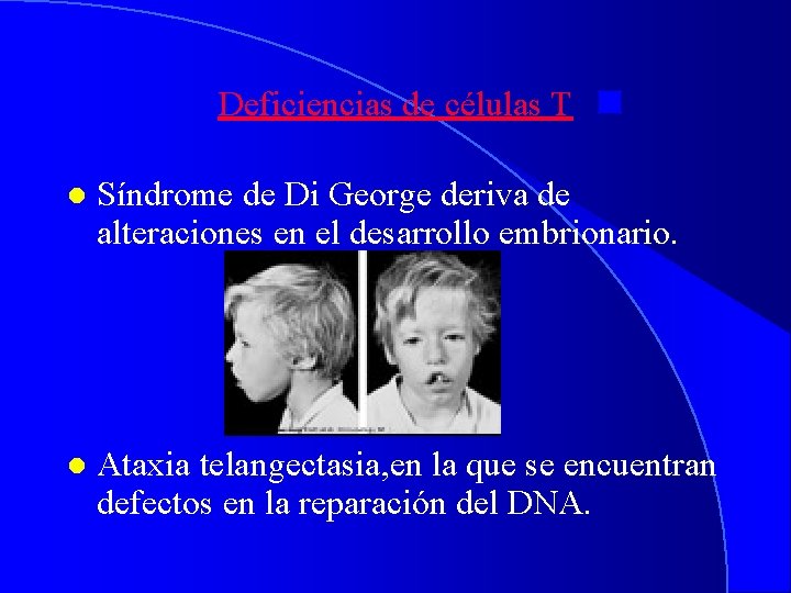 Deficiencias de células T l Síndrome de Di George deriva de alteraciones en el