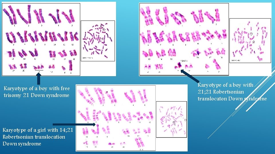 Karyotype of a boy with free trisomy 21 Down syndrome Karyotype of a girl