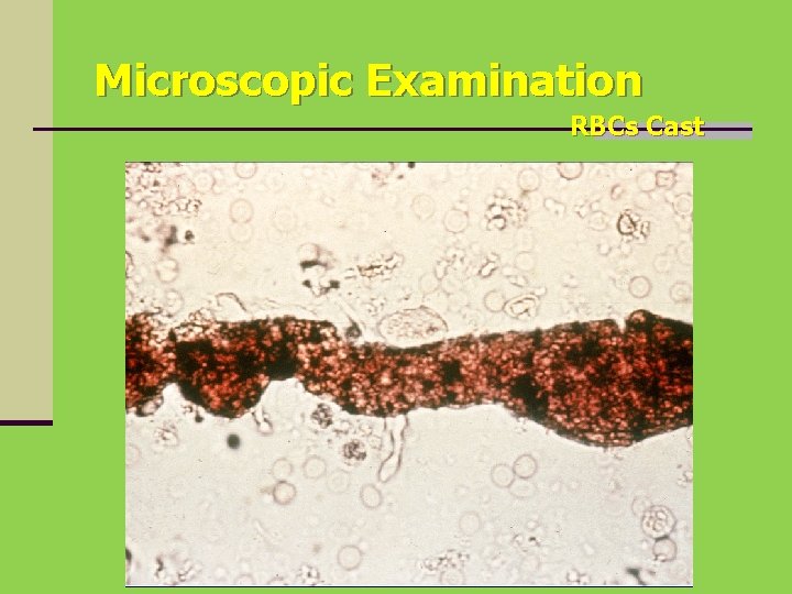 Microscopic Examination RBCs Cast 