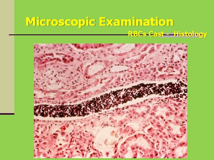 Microscopic Examination RBCs Cast - Histology 