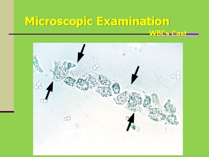 Microscopic Examination WBCs Cast 