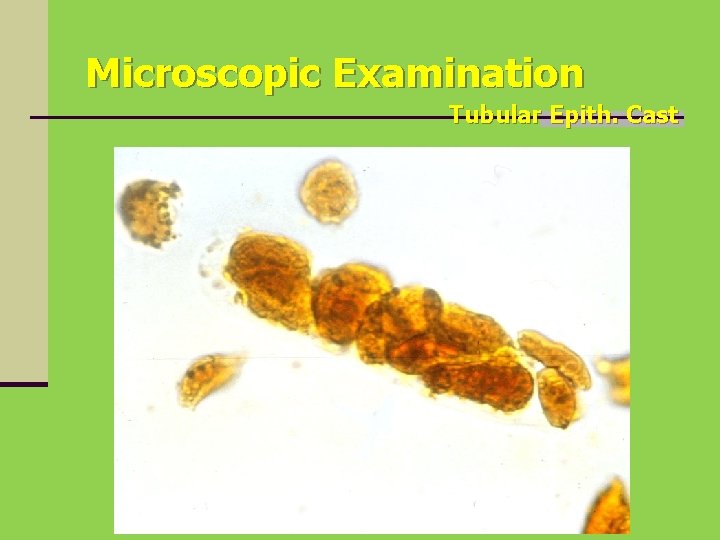 Microscopic Examination Tubular Epith. Cast 