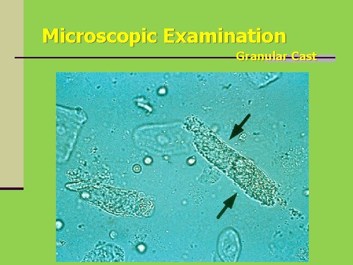 Microscopic Examination Granular Cast 