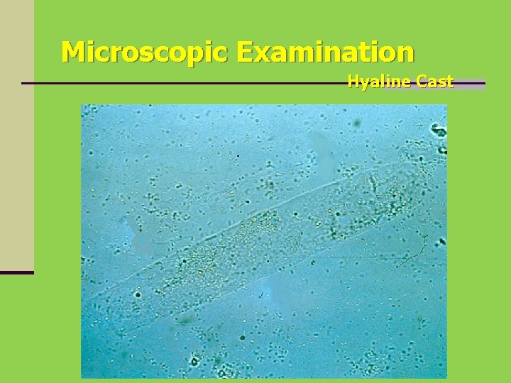 Microscopic Examination Hyaline Cast 