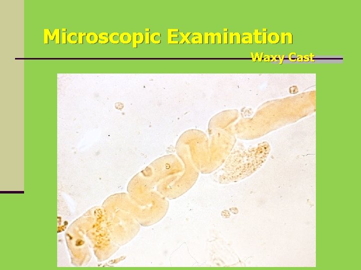Microscopic Examination Waxy Cast 