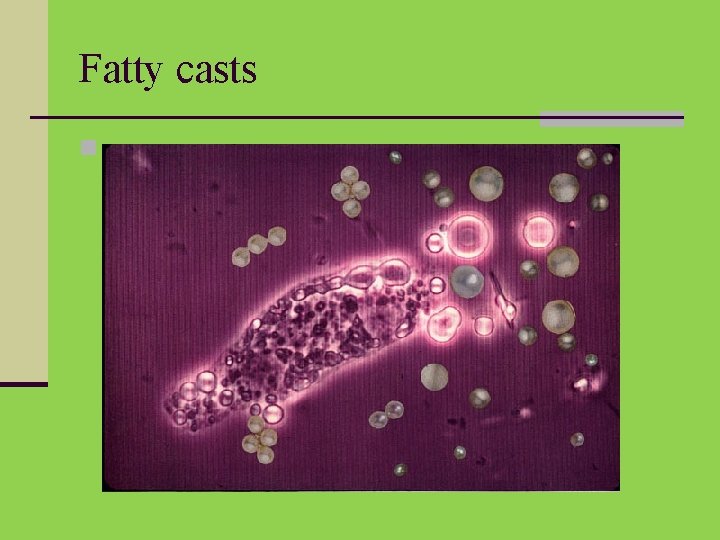 Fatty casts n 
