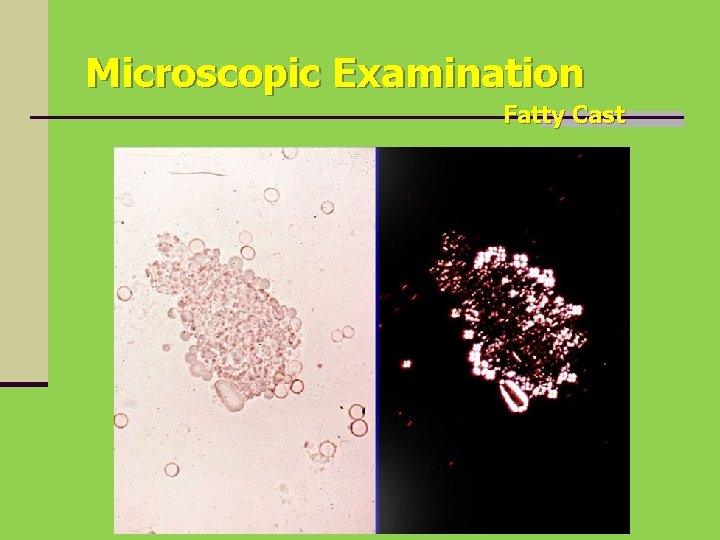 Microscopic Examination Fatty Cast 