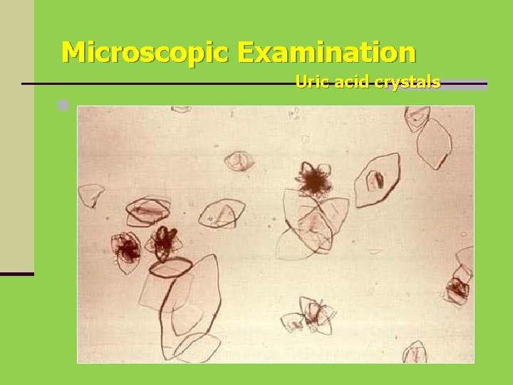 Microscopic Examination Uric acid crystals n 