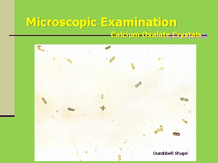 Microscopic Examination Calcium Oxalate Crystals Dumbbell Shape 