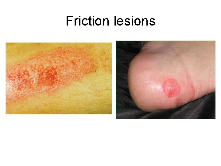 Friction lesions 