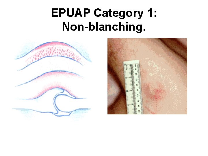 EPUAP Category 1: Non-blanching. 