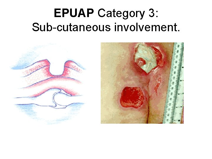 EPUAP Category 3: Sub-cutaneous involvement. 