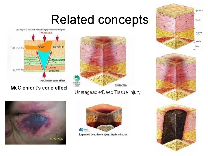 Related concepts Mc. Clemont’s cone effect Unstageable/Deep Tissue Injury 