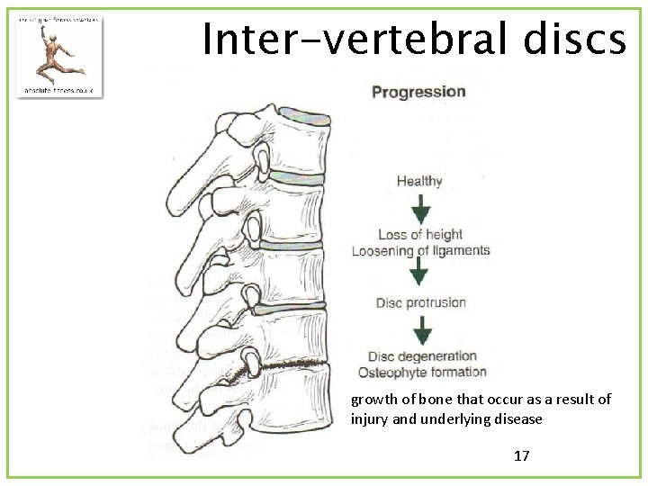 Inter-vertebral discs growth of bone that occur as a result of injury and underlying