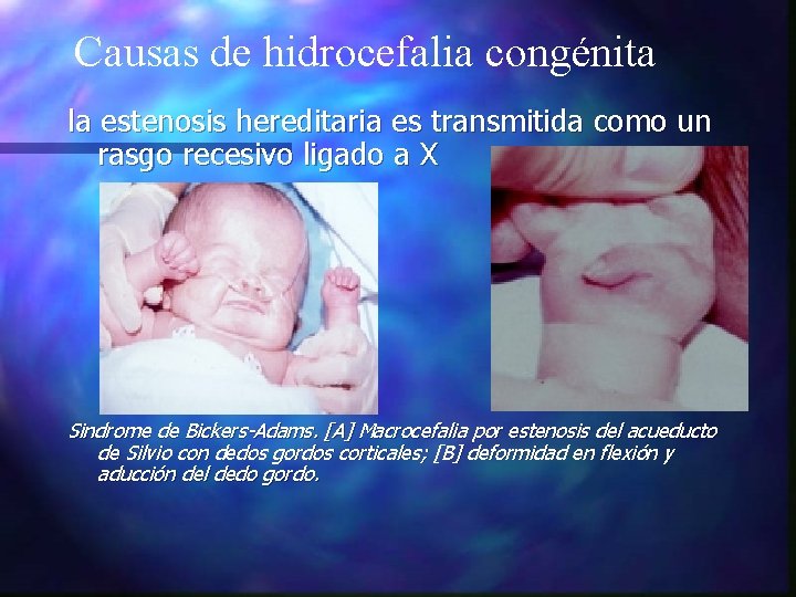 Causas de hidrocefalia congénita la estenosis hereditaria es transmitida como un rasgo recesivo ligado