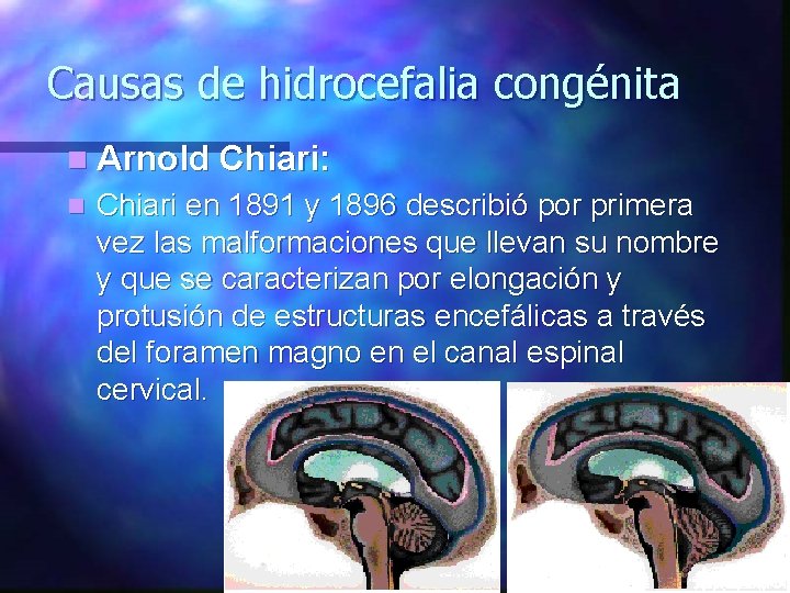 Causas de hidrocefalia congénita n Arnold Chiari: n Chiari en 1891 y 1896 describió