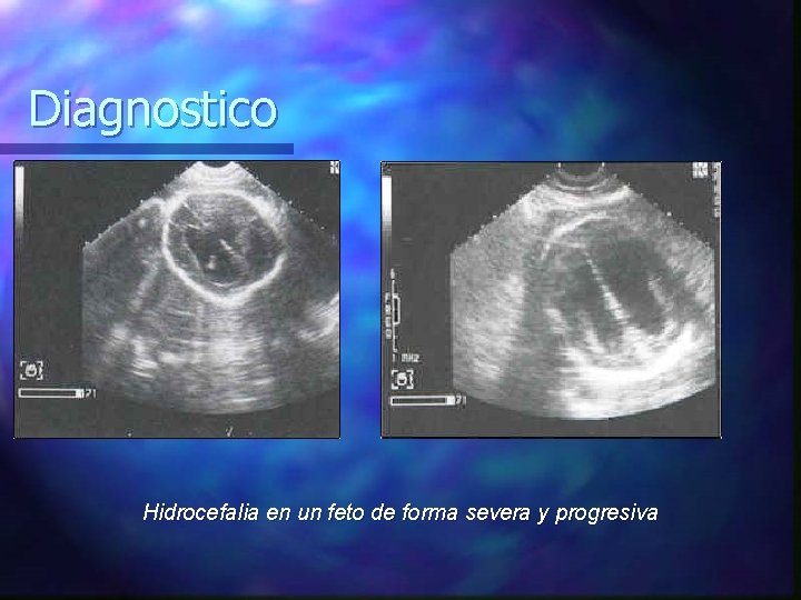 Diagnostico Hidrocefalia en un feto de forma severa y progresiva 