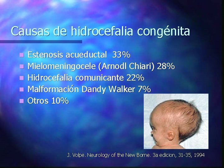 Causas de hidrocefalia congénita n n n Estenosis acueductal 33% Mielomeningocele (Arnodl Chiari) 28%