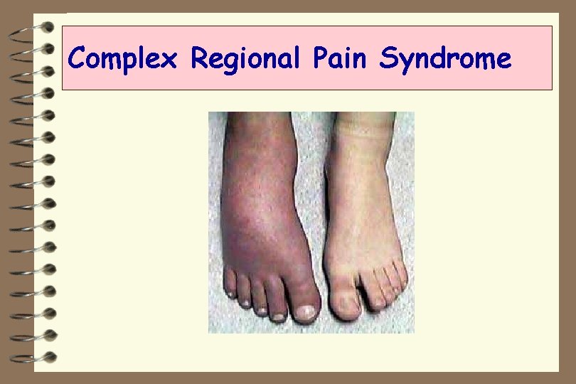 Complex Regional Pain Syndrome 