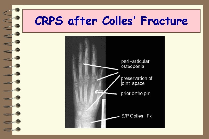CRPS after Colles’ Fracture 