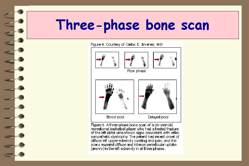 Three-phase bone scan 