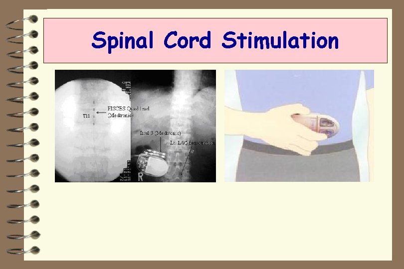 Spinal Cord Stimulation 